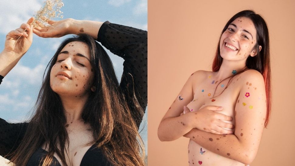 Beautiful from birth: Bullied for birthmark on her face but that didn't  stop her from being a model