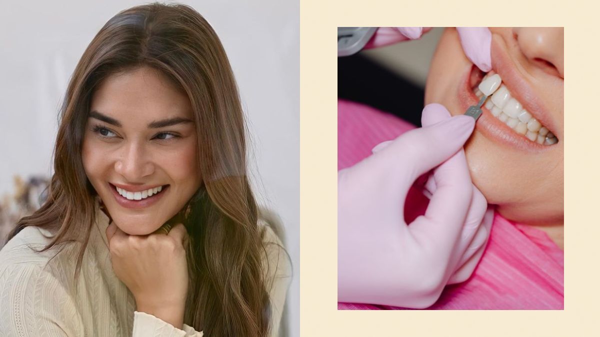 Everything You Need To Know About Veneers | Preview.ph